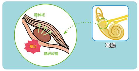 右邊耳鳴|耳鳴原因有哪些？這3種耳鳴可能是疾病警訊、5招改善。